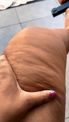 GIF Lipedema