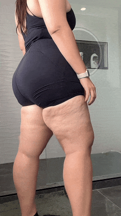 GIF Lipedema