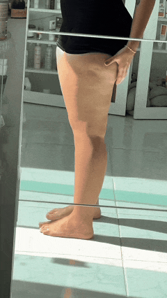 GIF Lipedema