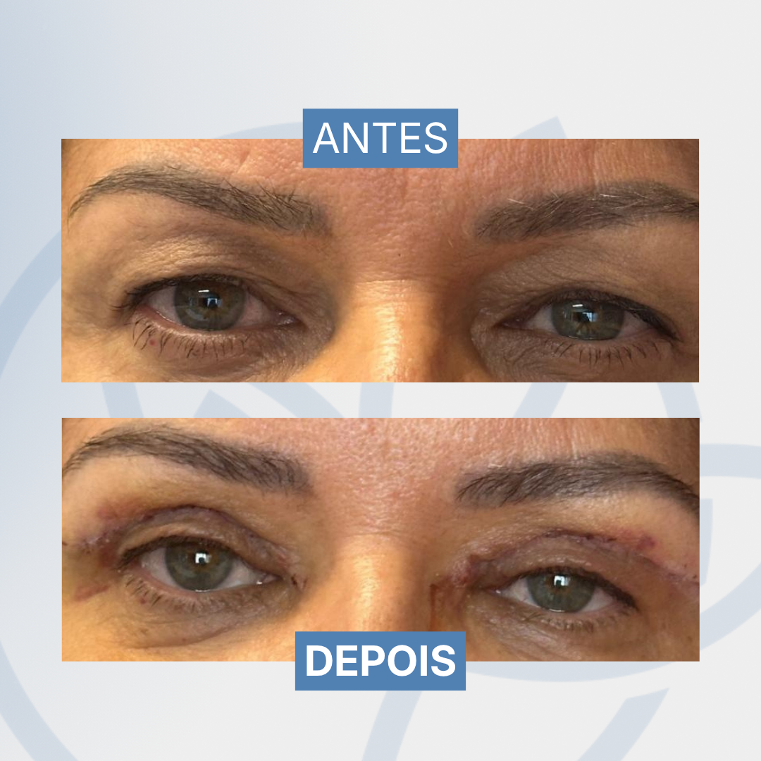 Blefaroplastia