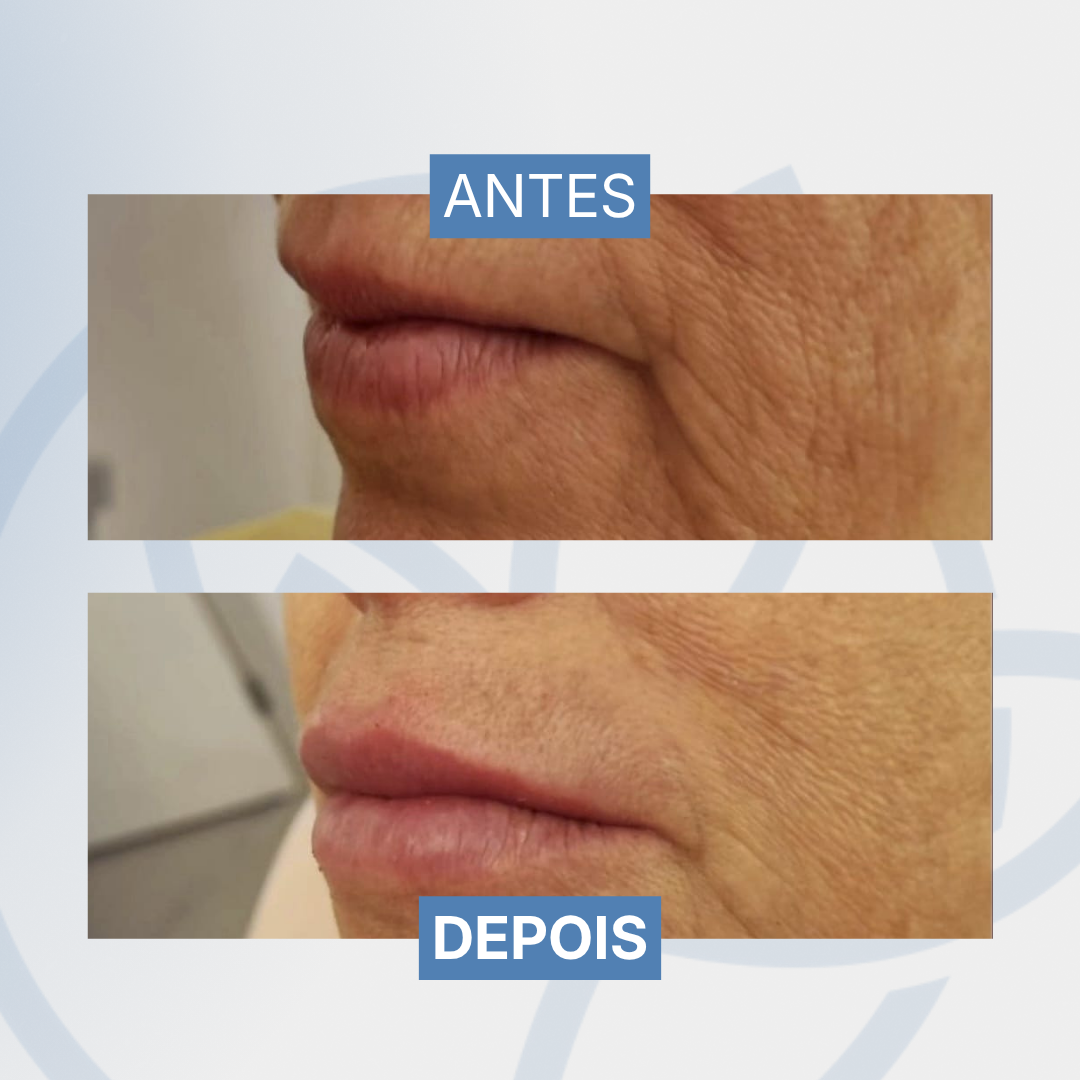 Preenchimento labial