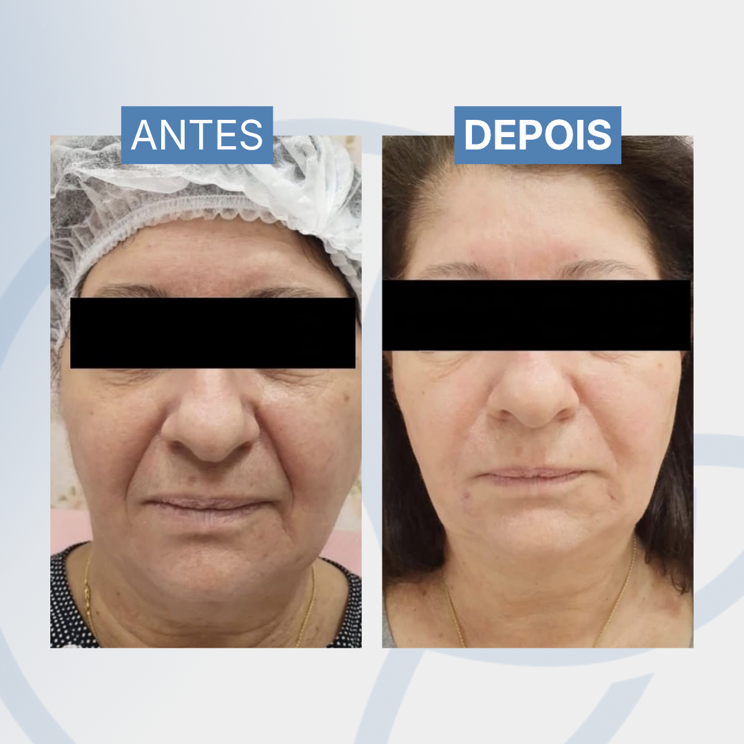 Bioestimulador de colágeno