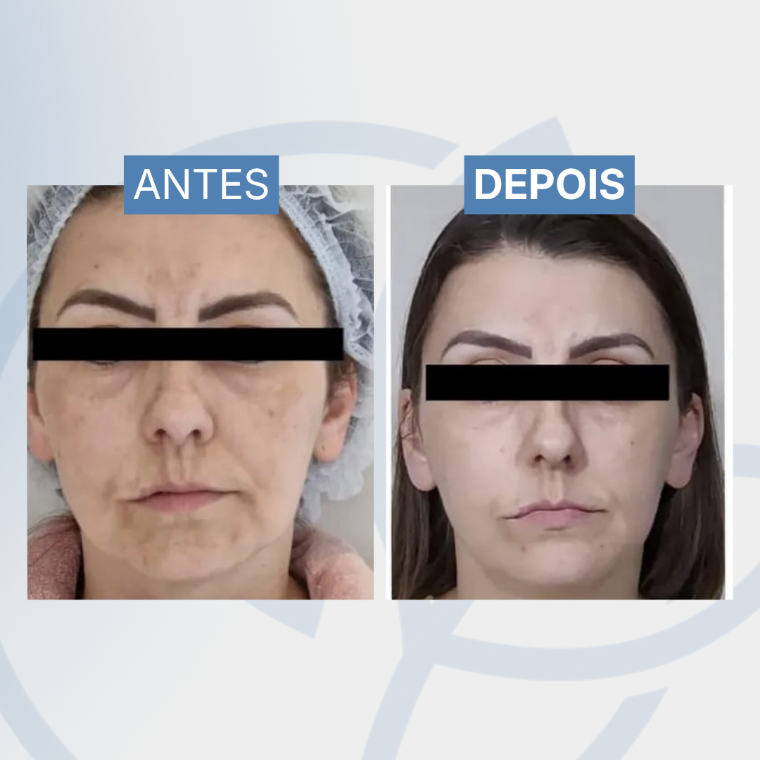 Lifting facial